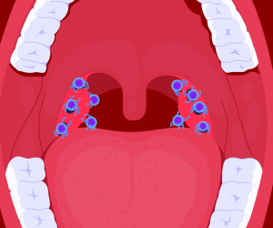 Три шага к диагнозу: как отличить ангину от обычной боли в горле за считанные секунды