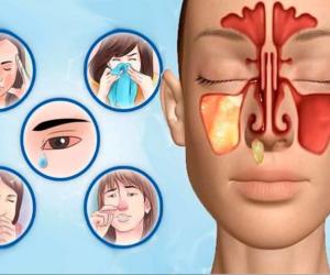 Оториноларинголог предупреждает: самолечение гайморита — это игра с огнем, где на кону стоит ваша жизнь