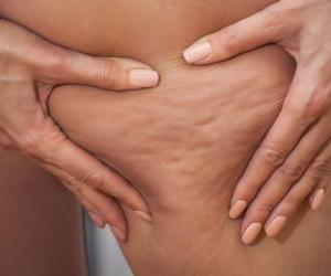 Секрет апельсиновой корки: врачи назвали настоящие причины целлюлита, о которых мало кто знает
