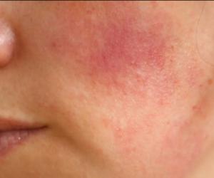 Холодовой дерматит: врачи назвали, у кого начнется «аллергия на мороз» этой зимой